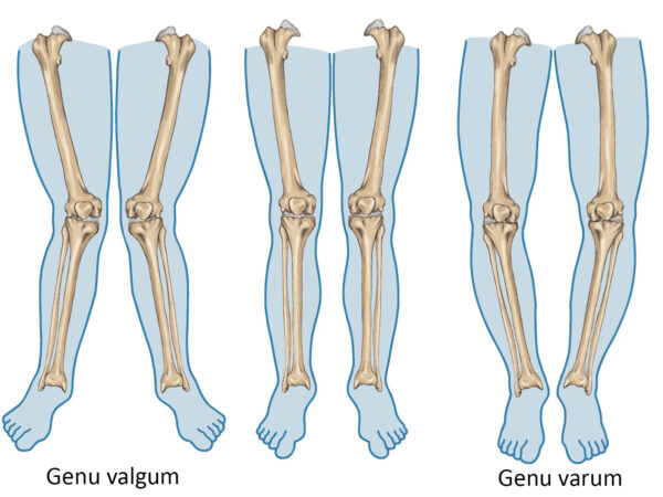 Déformations Axiales