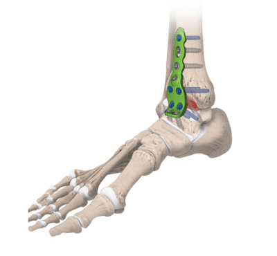 Arthrodèse de Cheville