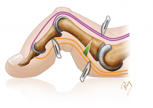 Chirurgie Percutanée des Orteils
