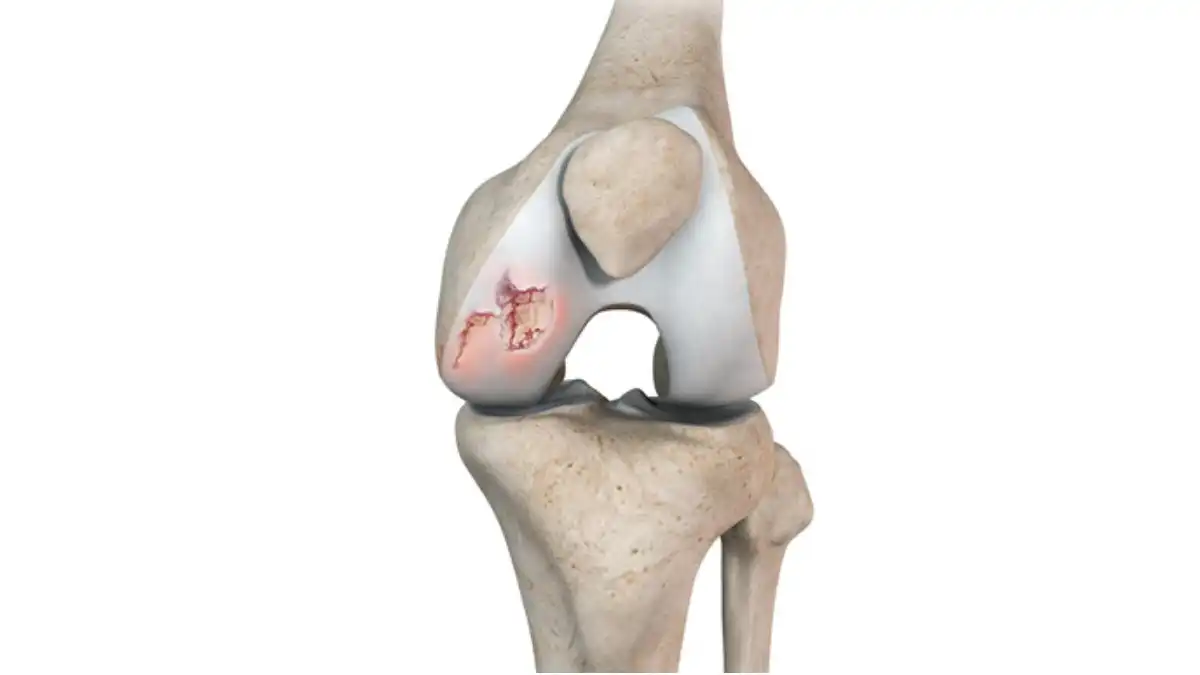 Gonarthrose