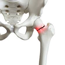 Fractures de l'extrémité supérieure du fémur