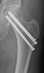 Traitement des fractures de l'extrémité supérieure du fémur