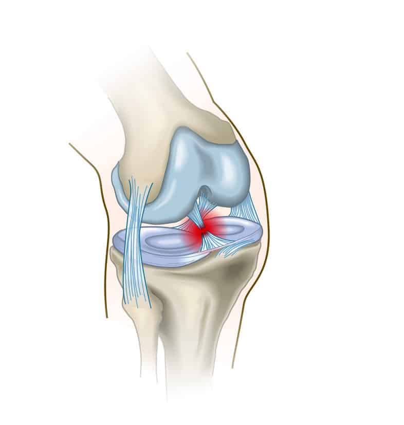 Rupture du Ligament Croisé Antérieur (LCA)