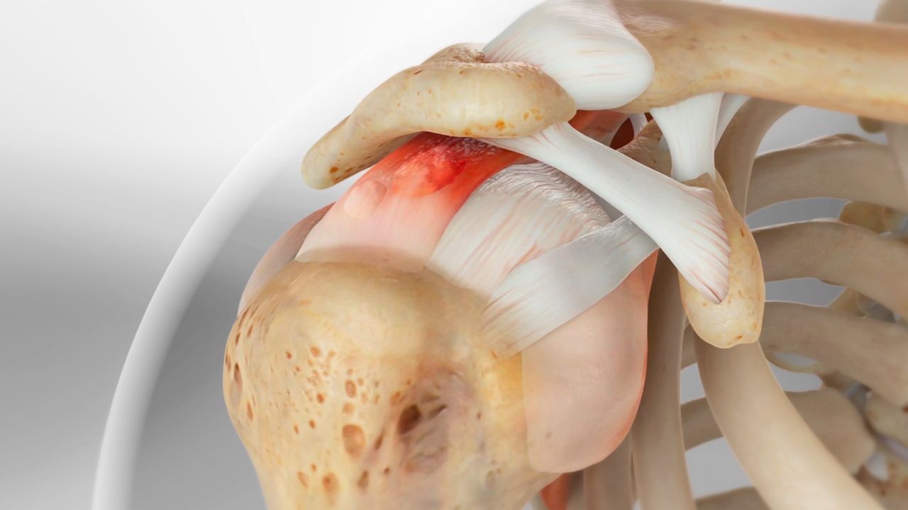Conflit Sous-Acromial & Tendinopathie Calcifiante