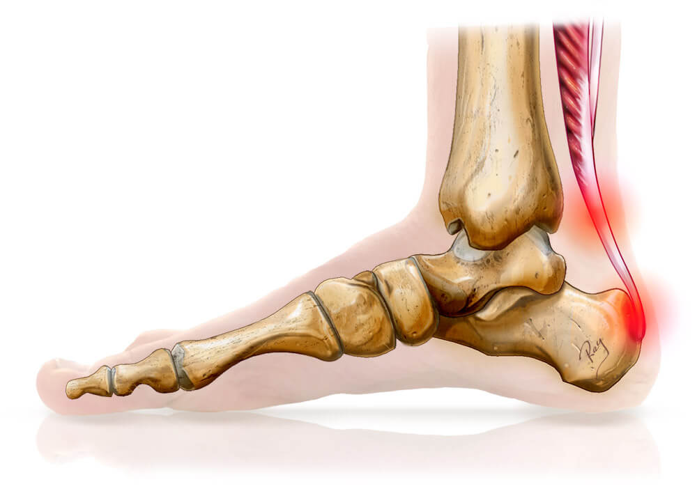 Tendinopathie Achilléenne